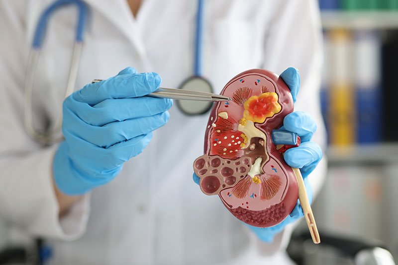 Manos de médico sosteniendo y señalando un modelo de riñones